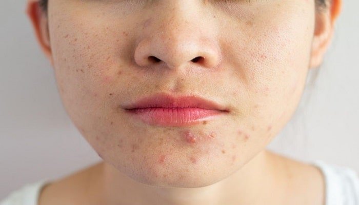 How to get rid of pimples to have an attractive skin
